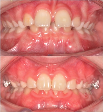 OAI Before and After Smile Gallery Mt. Pleasant IA, ORTHODONTIC ASSOCIATES  of IOWA