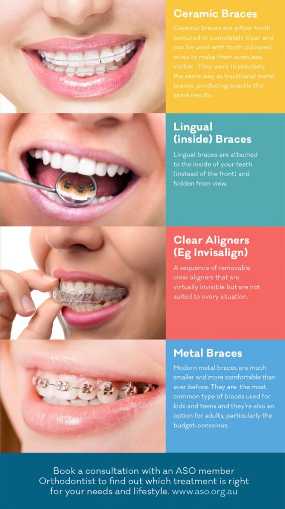 Best Clear Braces: Invisible Solutions for Adults