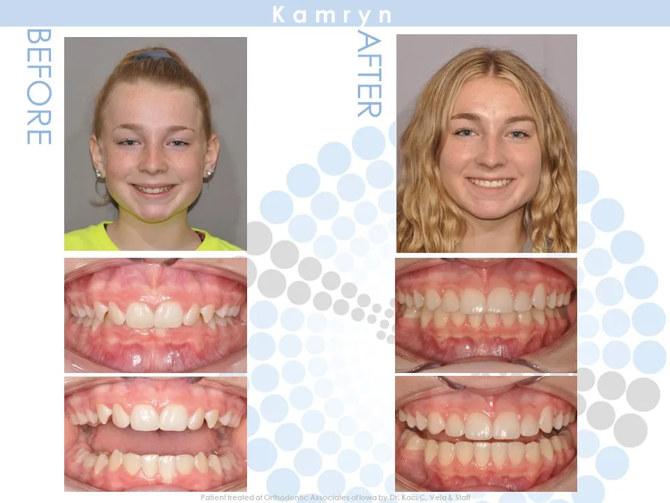 OAI Before and After Smile Gallery Mt. Pleasant IA, ORTHODONTIC ASSOCIATES  of IOWA