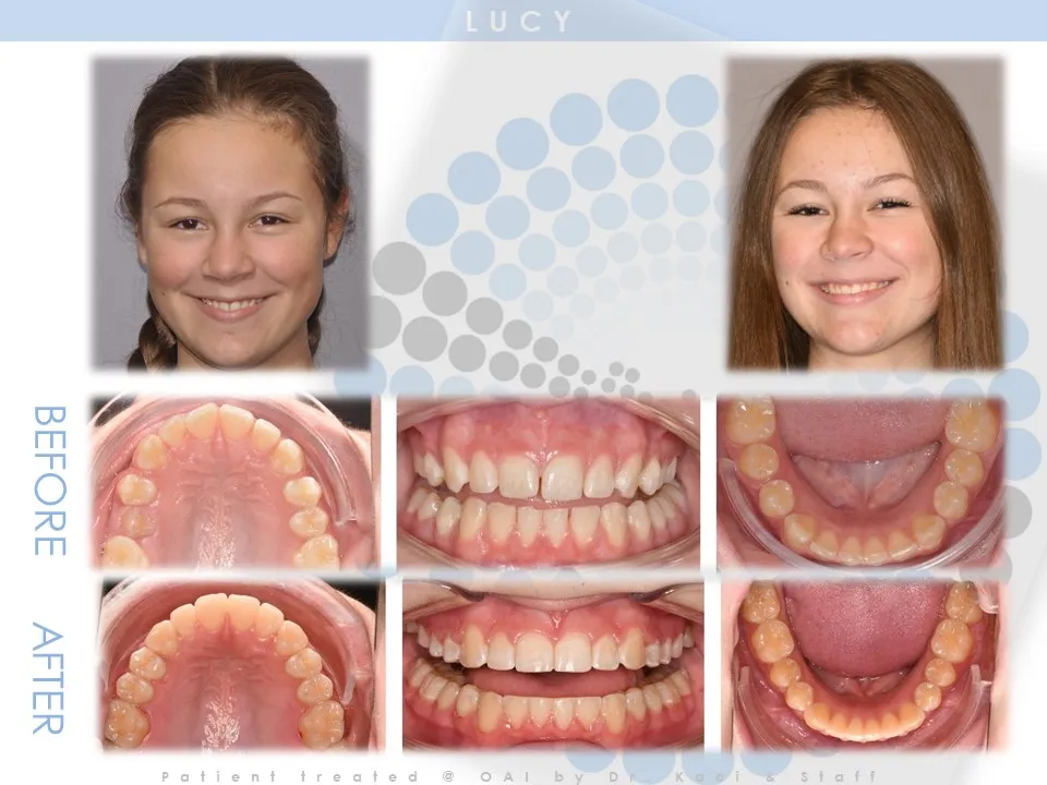 OAI Before and After Smile Gallery Mt. Pleasant IA, ORTHODONTIC ASSOCIATES  of IOWA